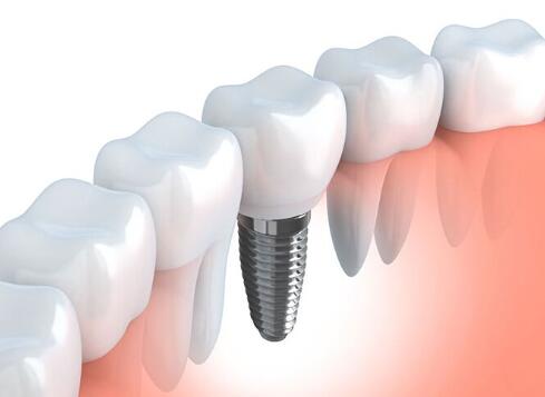 整個種植牙修復(fù)過程要多久-四川義齒廠家