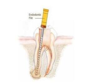 什么叫根管治療 | 四川義齒廠家