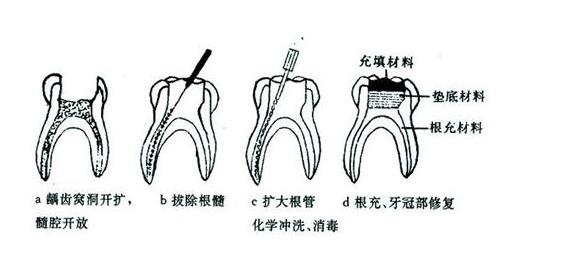 做根管治療大概要多久 | 成都義齒廠家