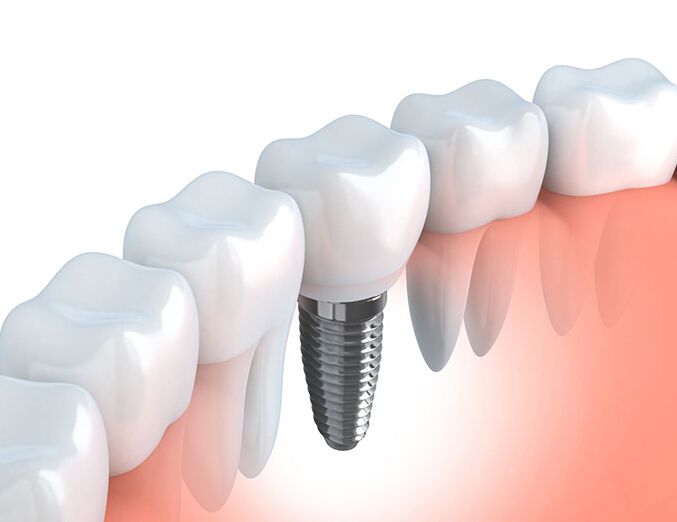 種植牙技術修復缺失牙齒的優(yōu)勢有哪些-四川種植牙廠家